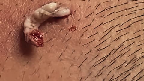 Blackheads Removal | Acne Treatment and Very Satisfying Satisfying Pimple pop #2 #blackheads