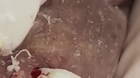 Blackheads Removal | Acne Treatment and Very Satisfying Satisfying Pimple pop #1 #blackheads
