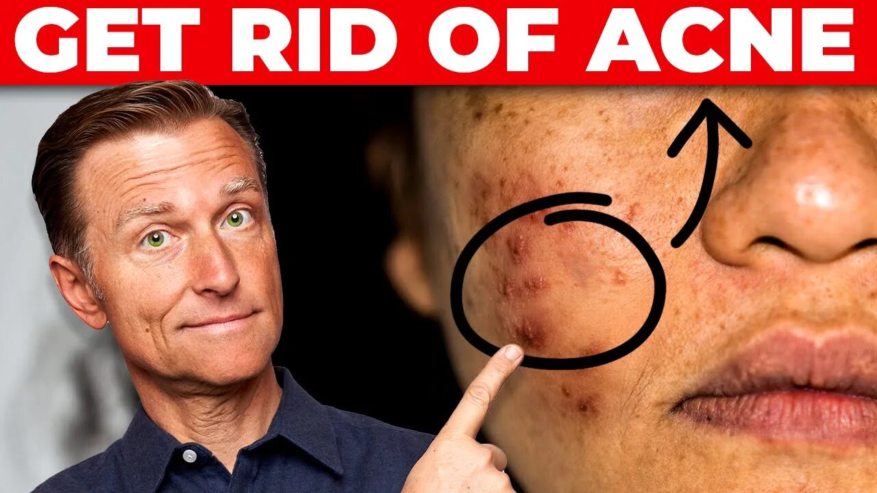 How I FINALLY Got Rid of My Acne!