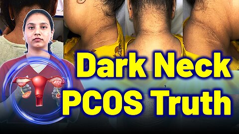 Why Women With PCOS Get Dark Neck, Dark Underarms, Skin Darkening, Acanthosis Nigricans?