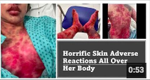 "Woman Experiences Severe Skin Reactions Post AstraZeneca, Baffling Doctors"