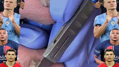 Ingrown Toenail Removal 2025 #ingrowntoenail #toenails #ingrown (35)