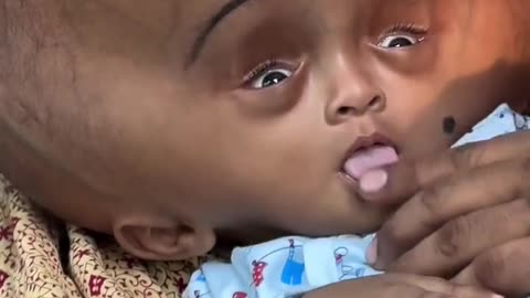 6 Months Old, 18 KG Head—This Baby Needs Your Prayers