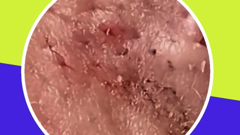 Blackhead removal new this week (ASMR) #9 #shorts
