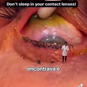 Mulher esquece de tirar lentes de contato antes de dormir