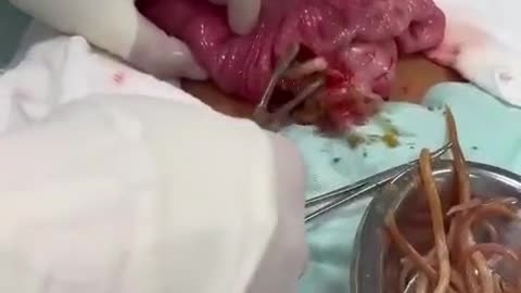 Sensitive video‼️Surgical intervention on a 9-year-old boy with intestinal obstruction caused by parasites