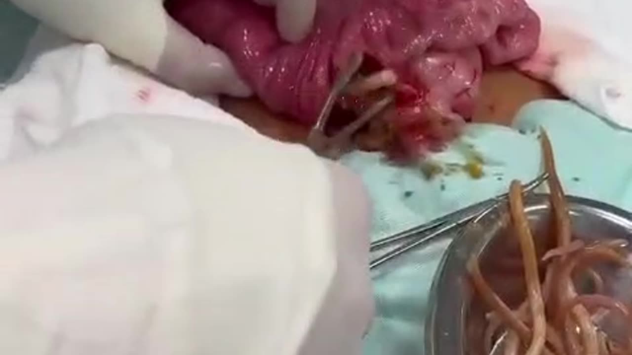 Sensitive video‼️Surgical intervention on a 9-year-old boy with intestinal obstruction caused by parasites