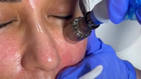 How Microneedling Helps with Scars and Skin Texture