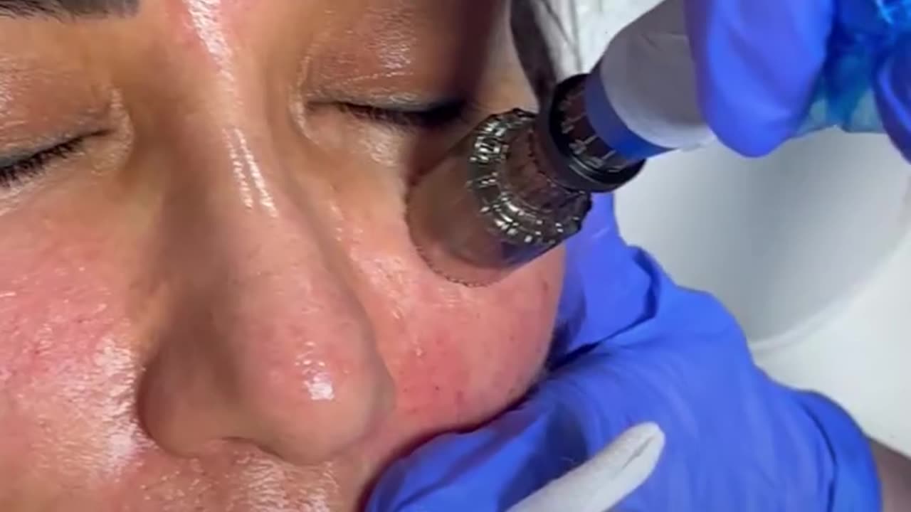 How Microneedling Helps with Scars and Skin Texture