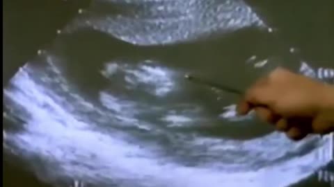 A Child Screams moments before being killed by abortion #abortionishealthcare