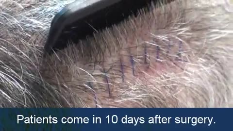 Dr. Brett Bolton Showcases His Undetectable Hair Restoration Scar Results