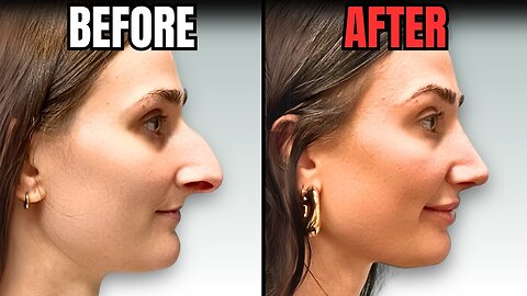 Woman Gets A Nose Job and Suddenly Her Husband WASN'T Good Enough