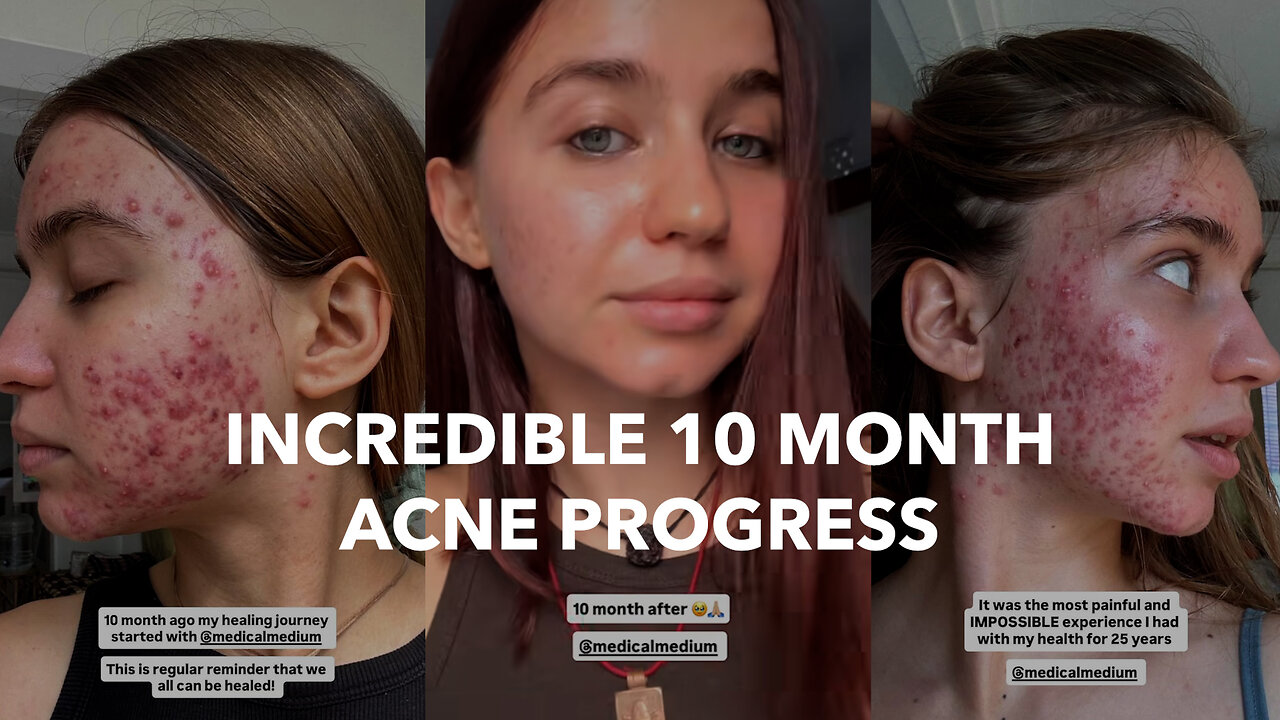 Incredible 10 Month Acne Progress