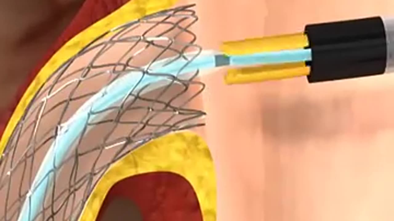 Heart Stent Placement #shorts
