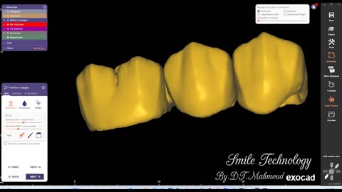 #design #naildesign #dental #dentaldesign #exocadexpert