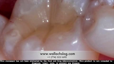 BAD TEETH Failing Tooth Enamel Dr Joel Wallach