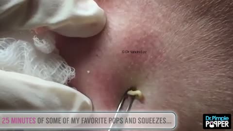 A Dr Pimple Popper Bedtime Story The Best Pops To Fall Asleep To TRAILER