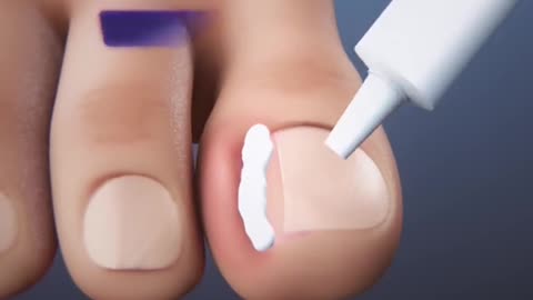 Ingrown Toenail Surgery 3D Animation