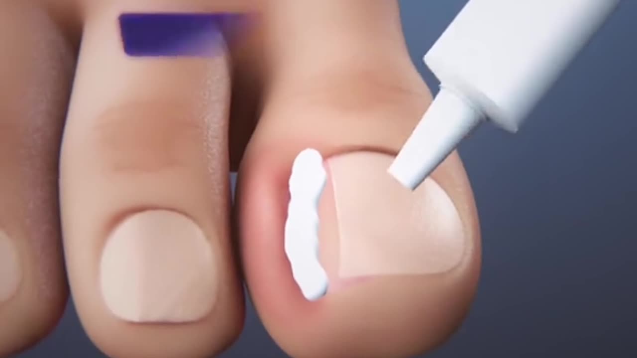 Ingrown Toenail Surgery 3D Animation