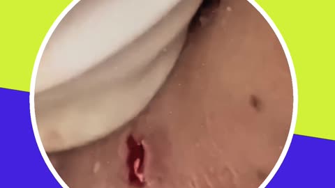 Blackhead removal new this week (ASMR) #13 #shorts
