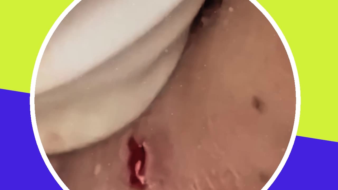Blackhead removal new this week (ASMR) #13 #shorts