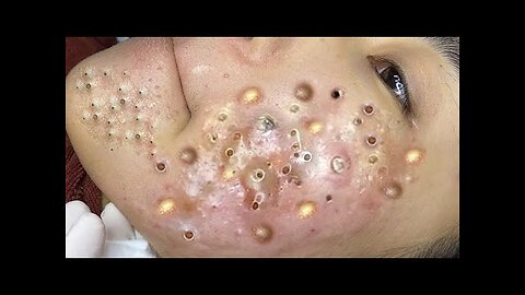 blackhead removal and Pimplepopper Spa relaxation #10111