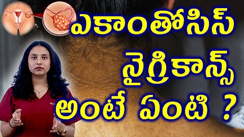 ఎకాంతోసిస్ నైగ్రికాన్స్ అంటే ఏంటి? What is Acanthosis Nigricans ? Skin Darkening in PCOS Treatment