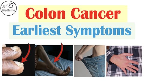 5 Early Symptoms of Colon Cancer (Colorectal Carcinoma)