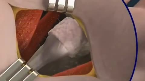 Trigger Finger Release Surgery Tendon Release Procedure for Finger Movement Rest