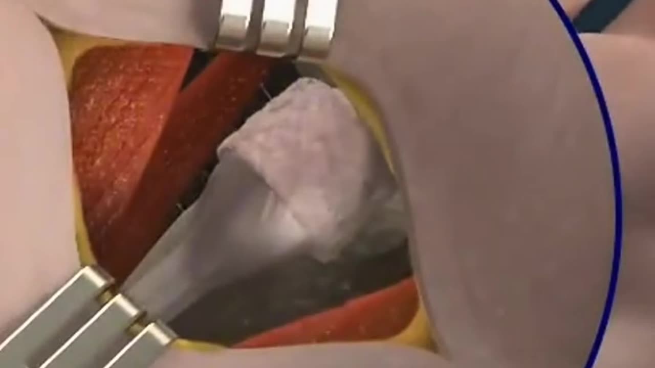 Trigger Finger Release Surgery Tendon Release Procedure for Finger Movement Rest