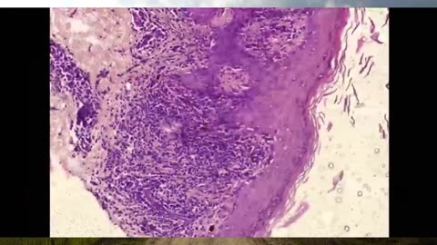 Pathologist Arne Burkhardt Final Interview - Revealing the Grave Dangers of mRNA Vaccines