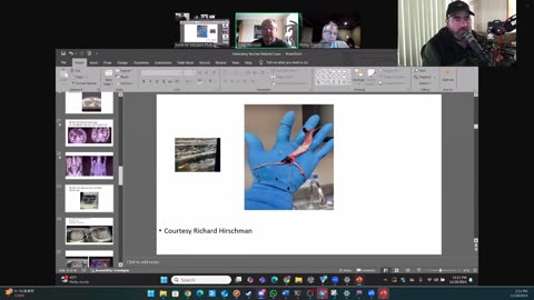 (CLIP) High Amyloidogenicity in Post-Mortem 'Calamari' Clots, Analyzing Clots Part 2
