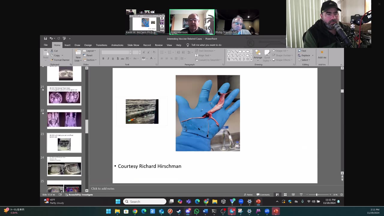 (CLIP) High Amyloidogenicity in Post-Mortem 'Calamari' Clots, Analyzing Clots Part 2