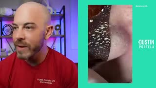 Shocking: Dermatologist Reacts to Viral TikToks | Cyst Popping, Pimple Popping