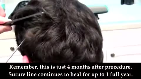 Dr. Brett Bolton Undetectable Hair Transplant Suture Line at 4 Months