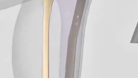 Tibia Interlocking Nail Surgery 🔩 Fixing Broken Leg Bone Step-by-Step