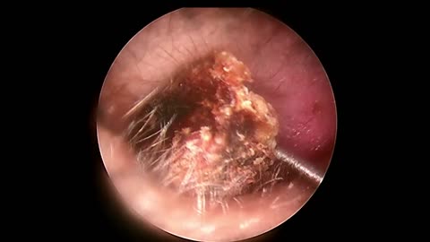 BIGGEST Ear Wax, Difficult Removal - EP2