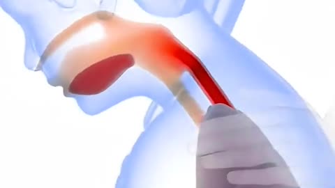 Choking First Aid – Save a Life in Seconds!