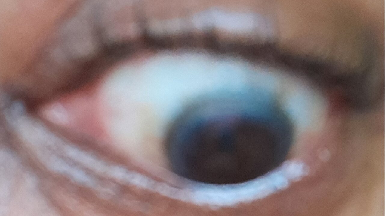 Nature’s Cure for DRY Eyes