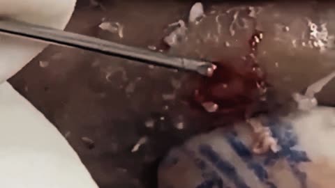New satisfying blackhead removal #11