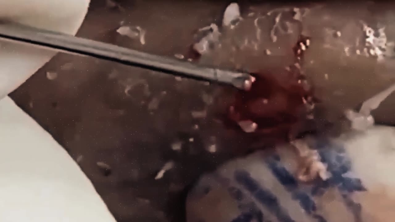 New satisfying blackhead removal #11
