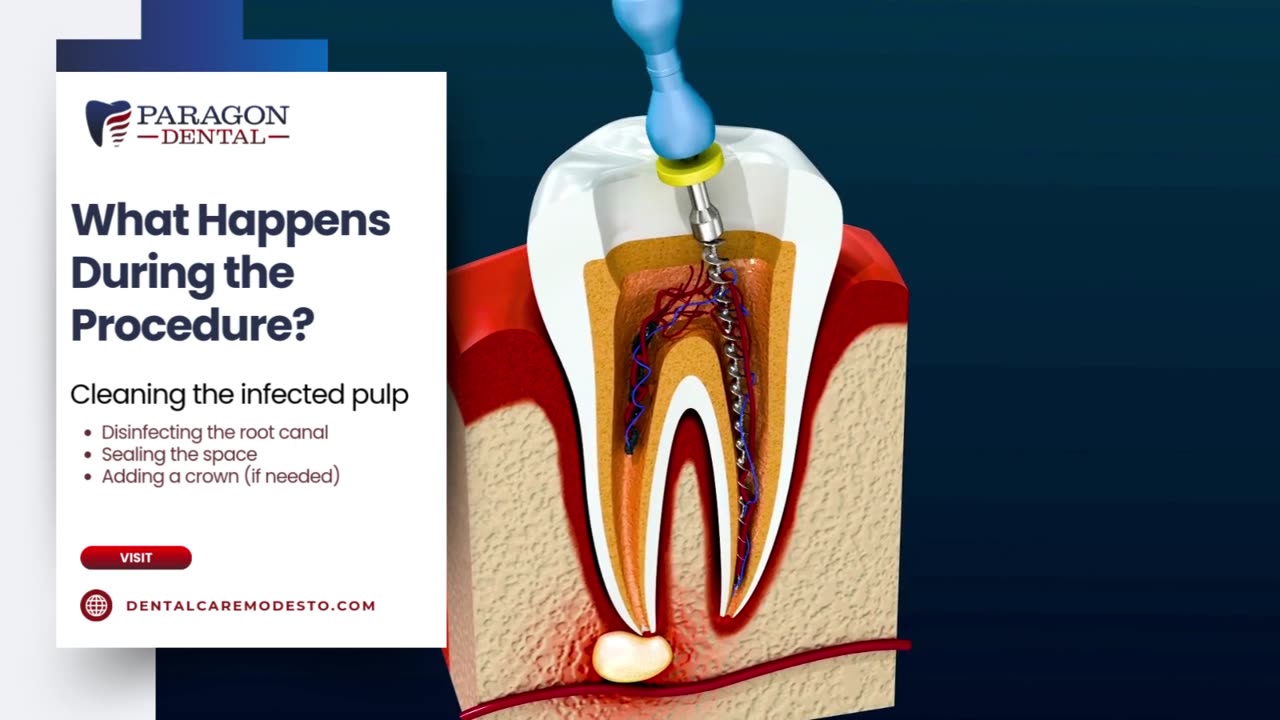 Root Canal Therapy for Teenagers