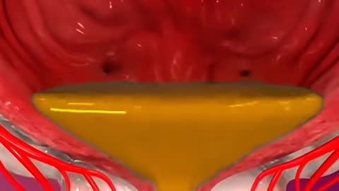 Prostate Artery Embolization The Minimally Invasive Treatment