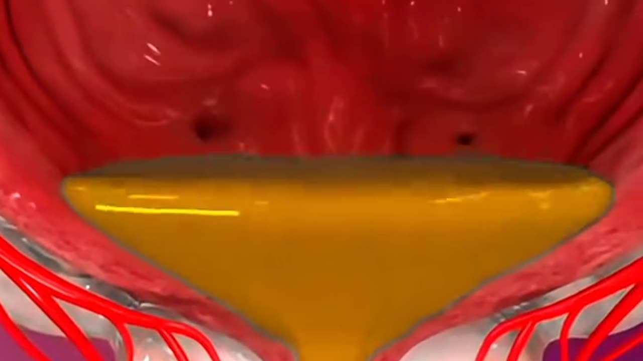 Prostate Artery Embolization The Minimally Invasive Treatment