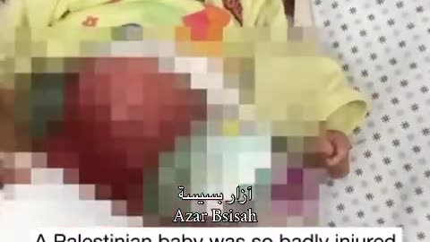4-month-old baby, suffers from a hole in his stomach due to inhaling toxic gases in Gaza