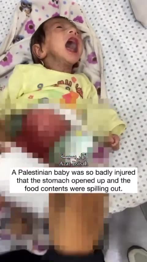 4-month-old baby, suffers from a hole in his stomach due to inhaling toxic gases in Gaza