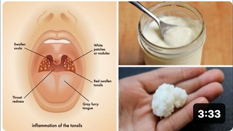 "Quick and Effective Home Remedies for Tonsil Stones (Tonsilloliths)"