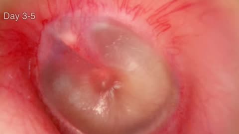 Ear Infection Timelapse Video 3D Animation