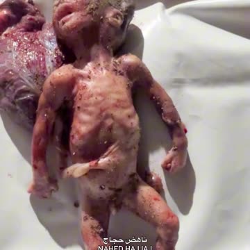 A fetus emerged from the womb of his martyred mother, not yet born into life (Graphic)