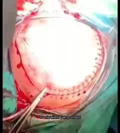 SZCZEPIONKA POWODUJE MASOWE ZAKRZEPY KRWI W MÓZGU 🩸 🧠